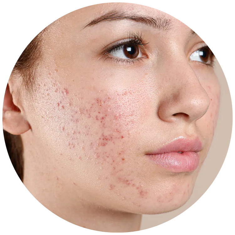 Acnes & Breakouts