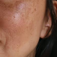 Pigmentation & Dark Spots